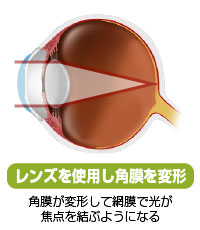 レンズを使用し角膜を変形