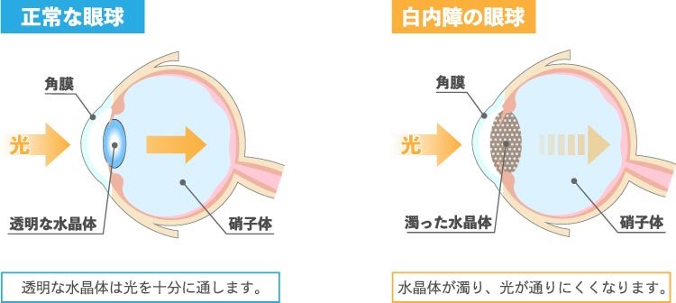 正常な目と白内障の目の説明イラスト