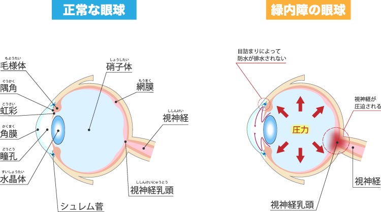 正常な目と緑内障の目の説明イラスト