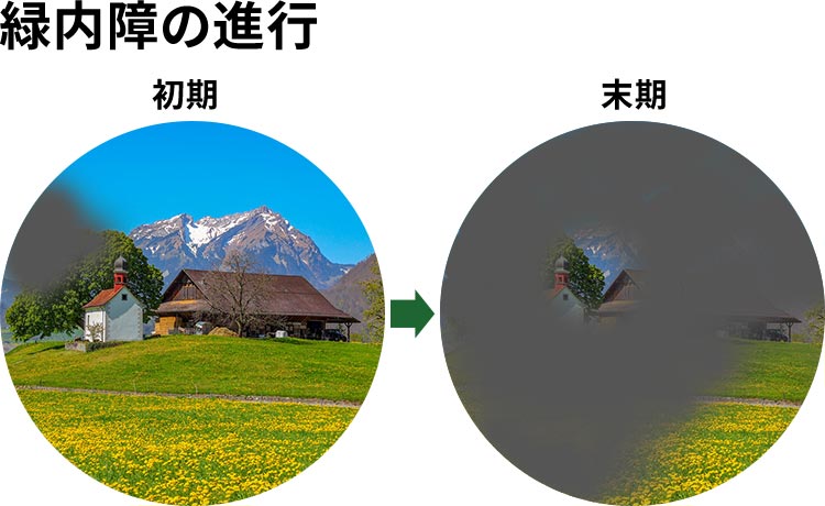 緑内障の見え方のイメージ写真