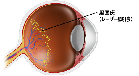 レーザー光凝固術のイメージ画像