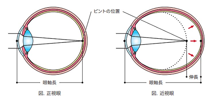 近視のイメージ画像02