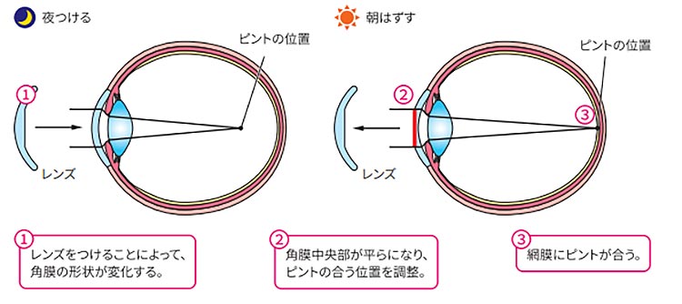 オルソケラトロジーのイメージ画像